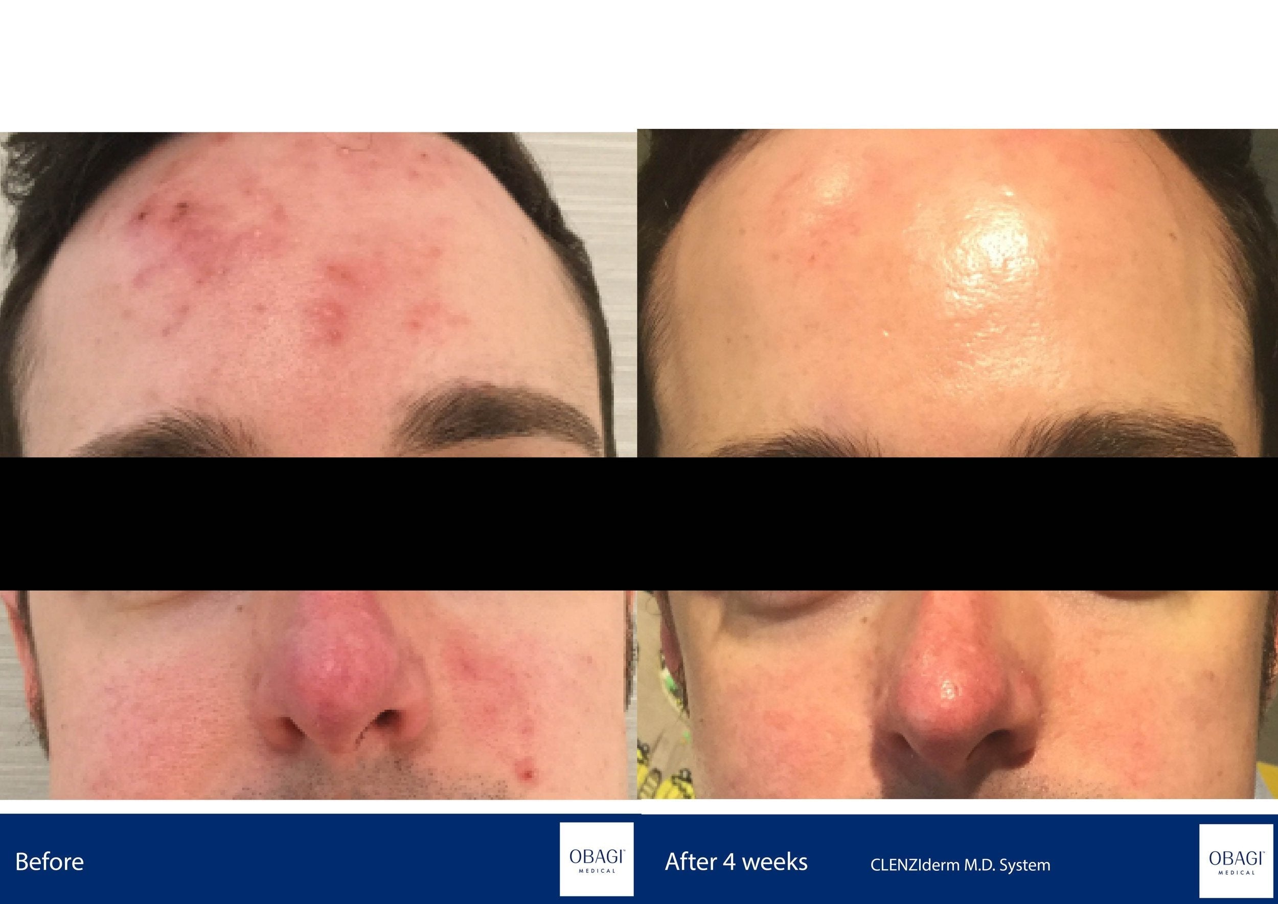 CLENZIderm System. Before After. Obagi Medical. Worldwide international shipping. Official stockist. UK Ambassador Clinic.