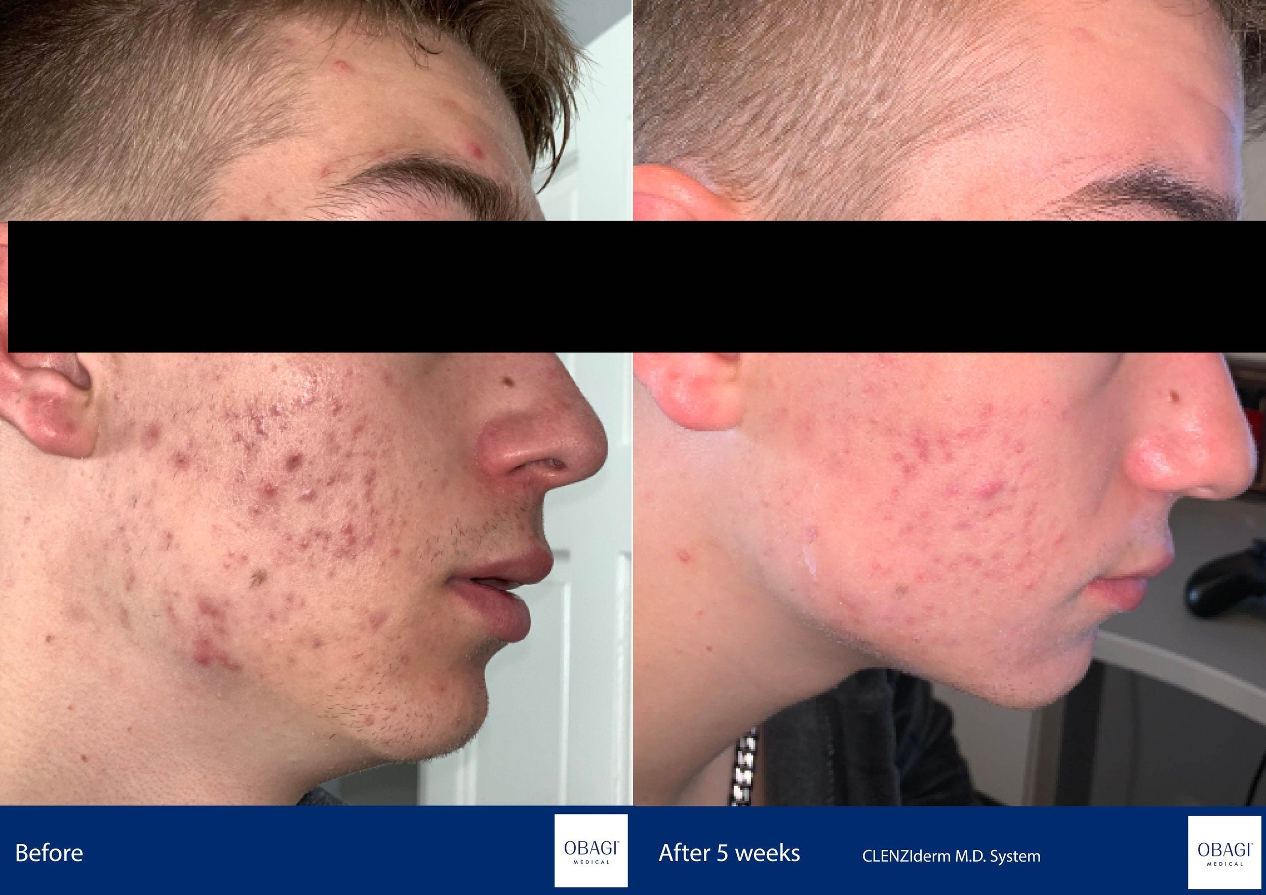 CLENZIderm System. Before After. Obagi Medical. Worldwide international shipping. Official stockist. UK Ambassador Clinic.