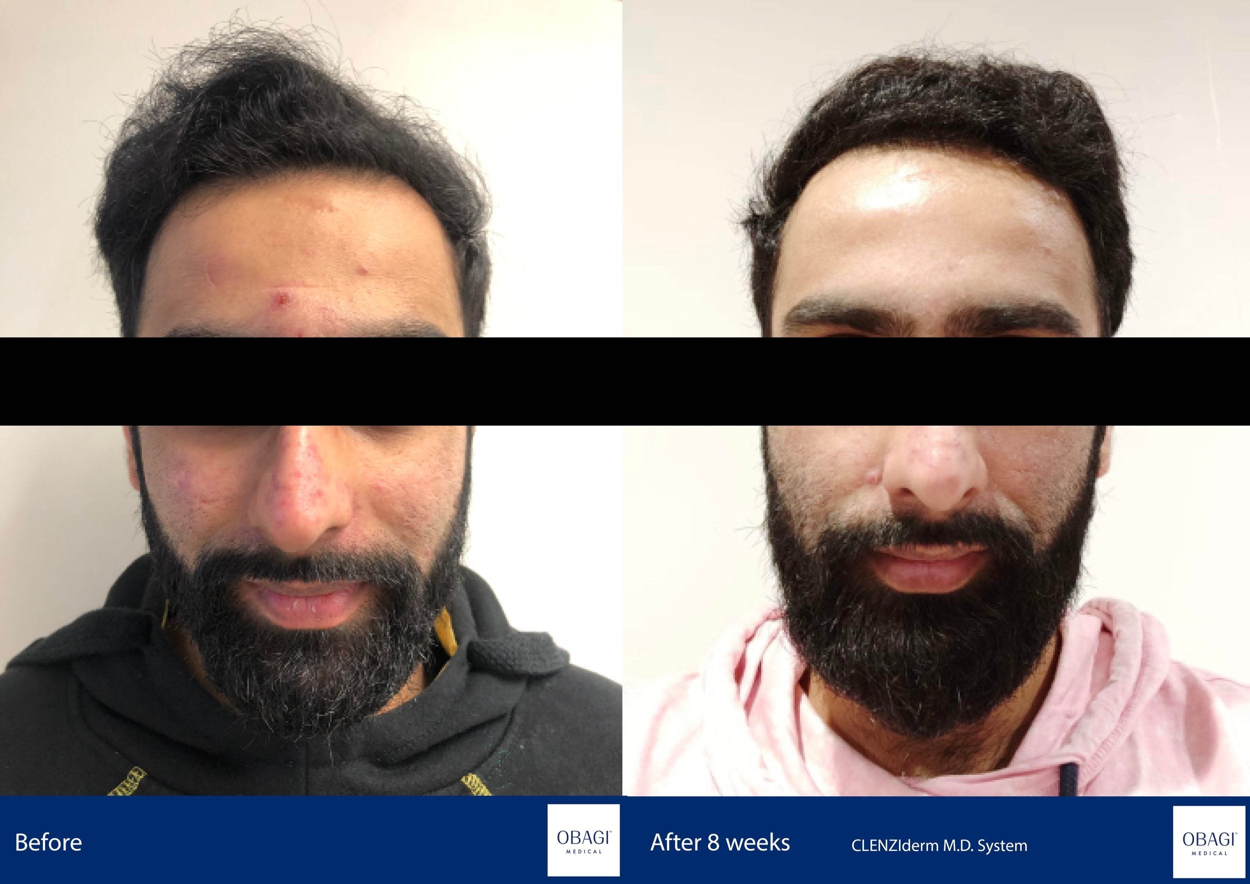 CLENZIderm System. Before After. Obagi Medical. Worldwide international shipping. Official stockist. UK Ambassador Clinic.