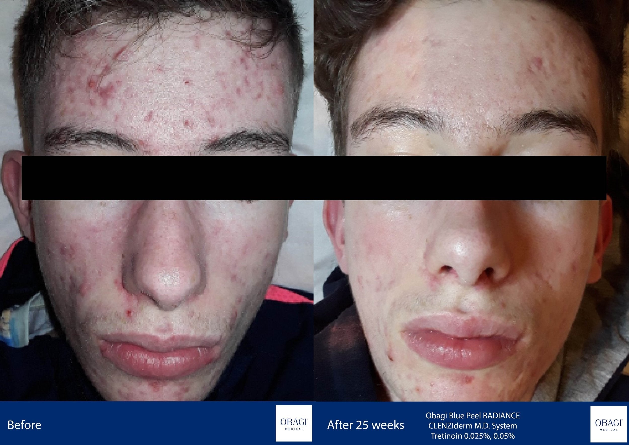 CLENZIderm System. Before After. Obagi Medical. Worldwide international shipping. Official stockist. UK Ambassador Clinic.