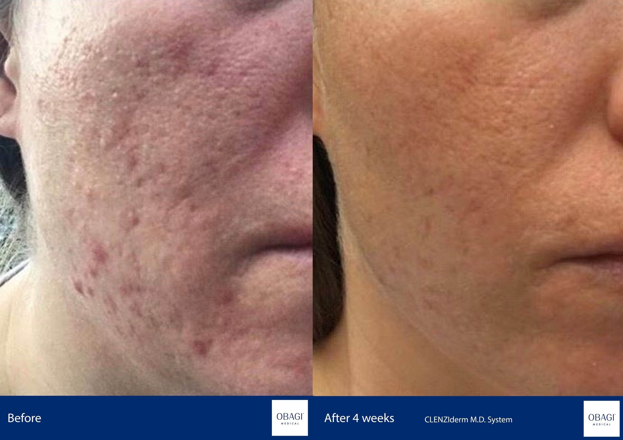 CLENZIderm System. Before After. Obagi Medical. Worldwide international shipping. Official stockist. UK Ambassador Clinic.