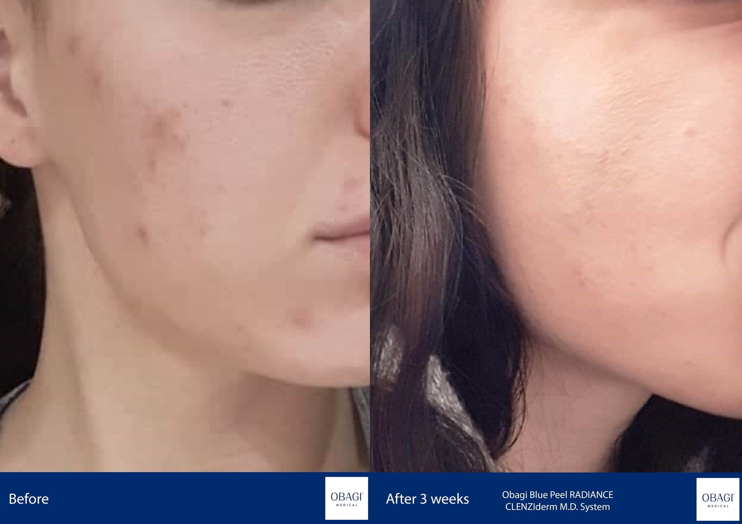 CLENZIderm System. Before After. Obagi Medical. Worldwide international shipping. Official stockist. UK Ambassador Clinic.