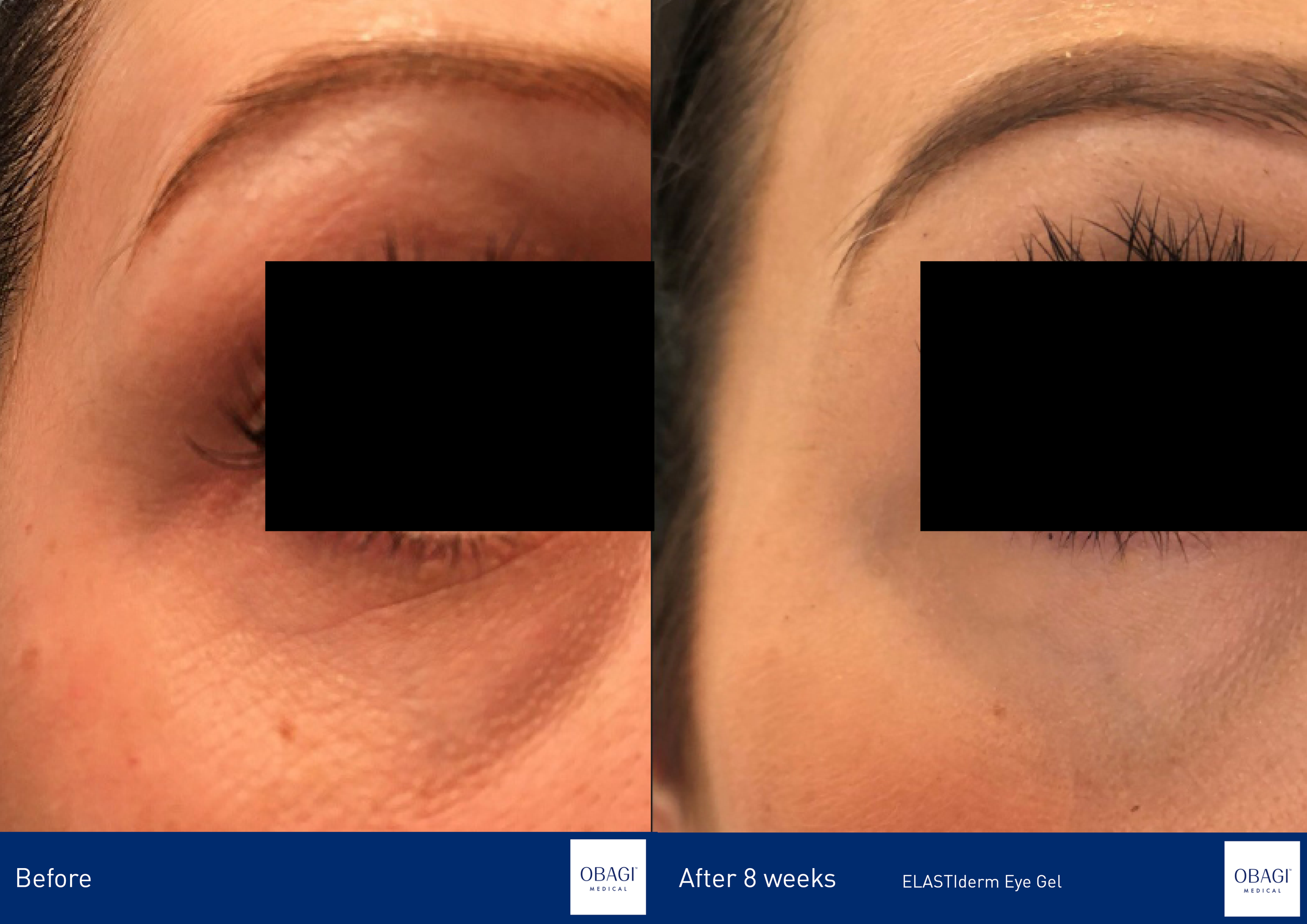 ELASTIderm Eye Complete Complex Serum. Before After. Obagi Medical. Worldwide international shipping. Official stockist. UK Ambassador Clinic.