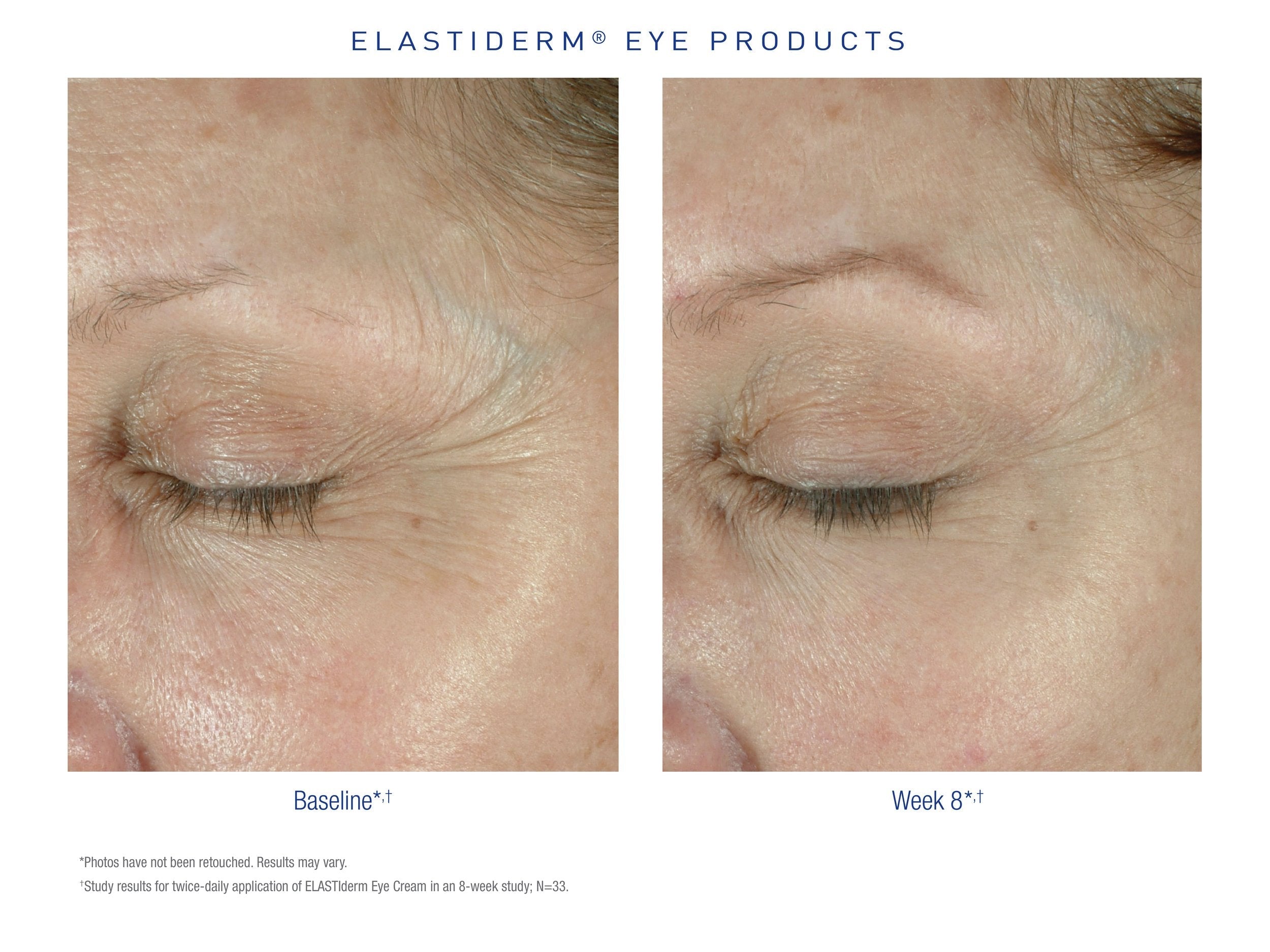 ELASTIderm Eye Cream. Before After. Obagi Medical. Worldwide international shipping. Official stockist. UK Ambassador Clinic.