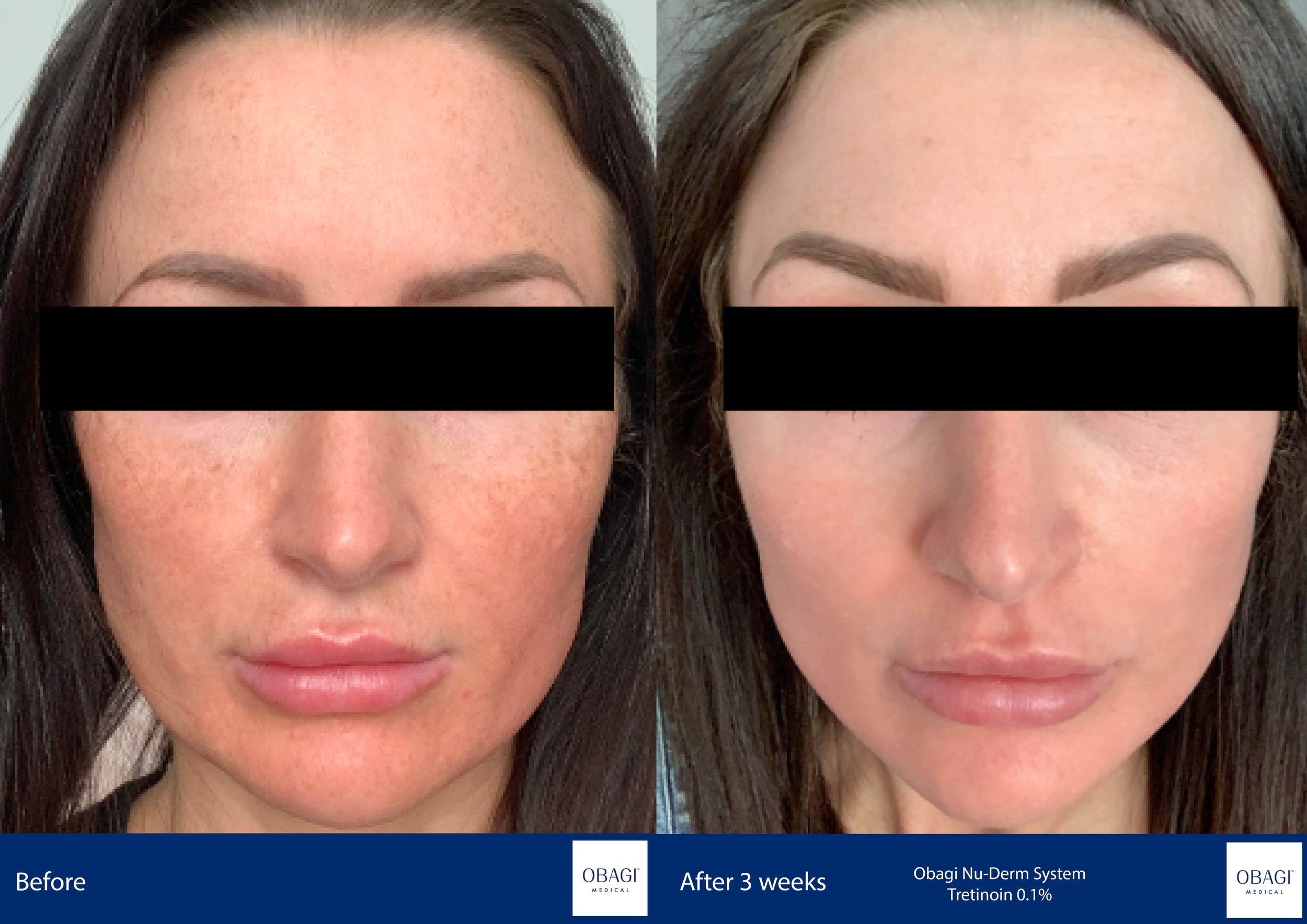 Nu-Derm Skin Transformation System - Normal to Dry. Before After. Obagi Medical. Worldwide international shipping. Official stockist. UK Ambassador Clinic.