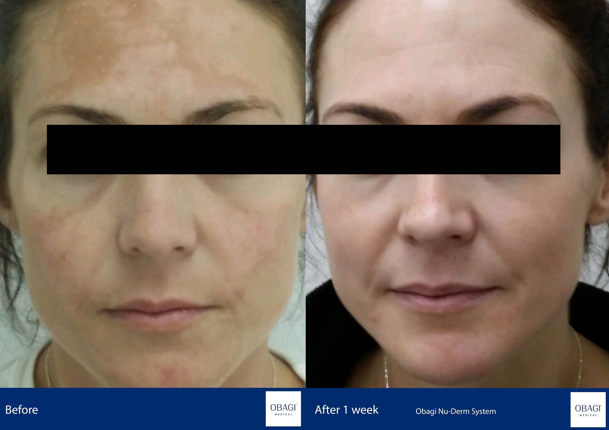 Nu-Derm Skin Transformation System - Normal to Dry. Before After. Obagi Medical. Worldwide international shipping. Official stockist. UK Ambassador Clinic.