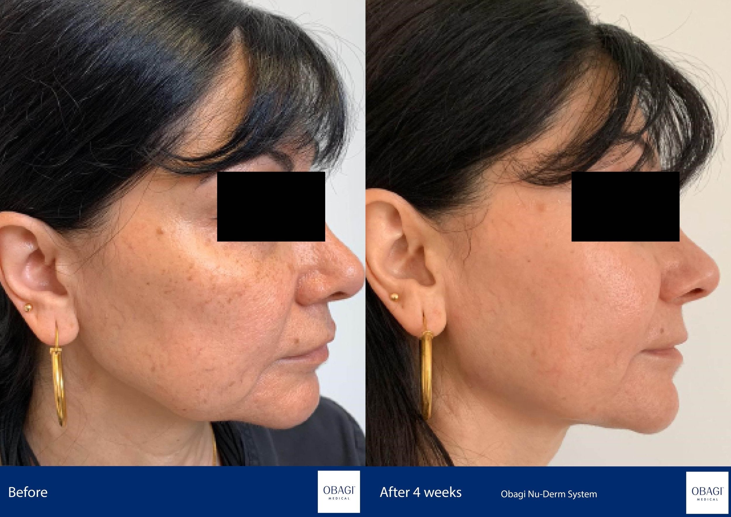 Nu-Derm Skin Transformation System - Normal to Dry. Before After. Obagi Medical. Worldwide international shipping. Official stockist. UK Ambassador Clinic.