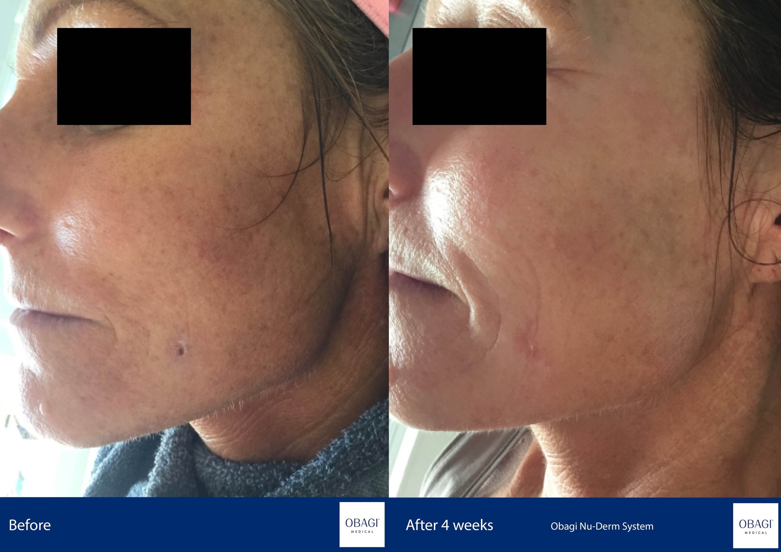 Nu-Derm Skin Transformation System - Normal to Oily. Before After. Obagi Medical. Worldwide international shipping. Official stockist. UK Ambassador Clinic.