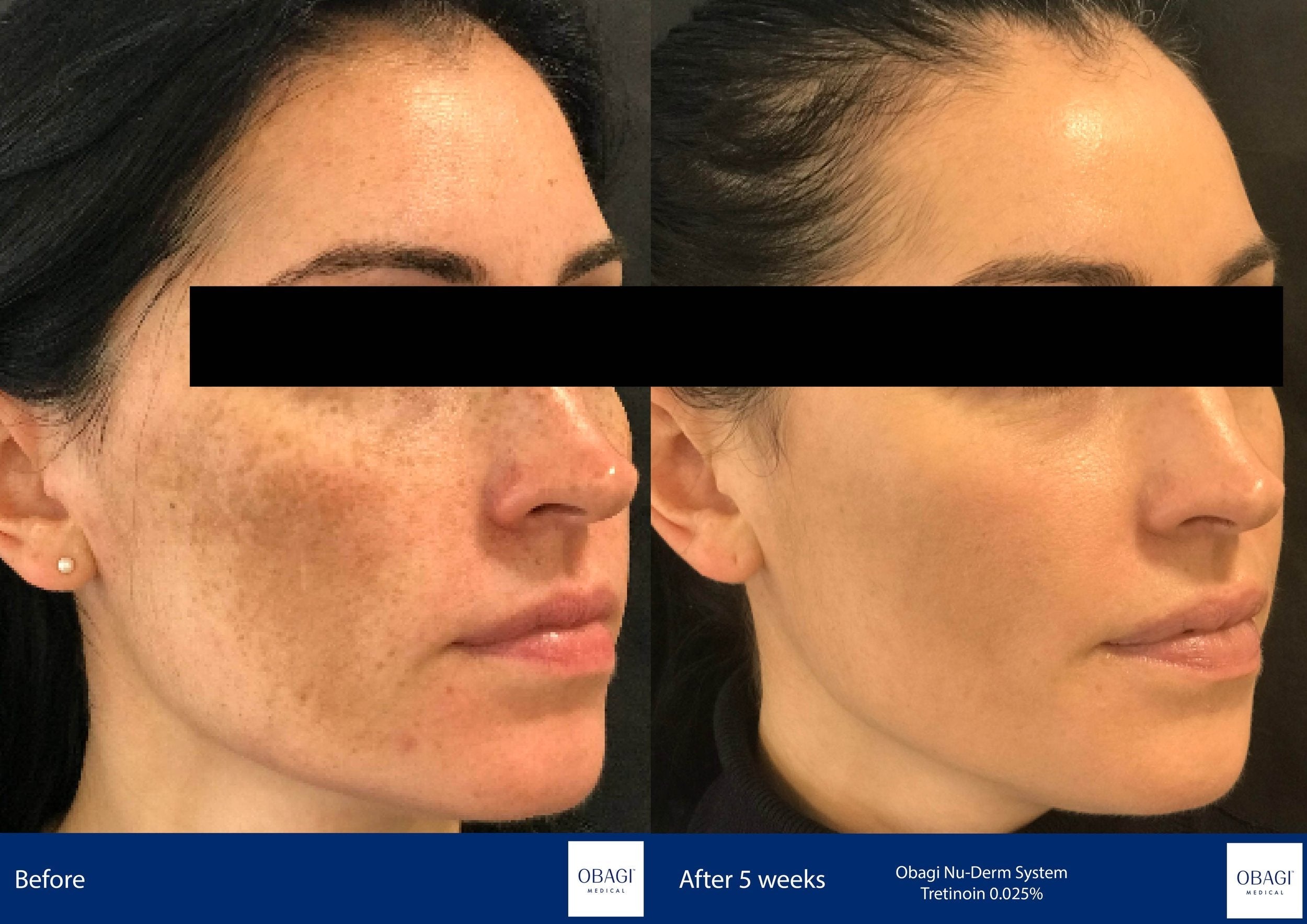 Nu-Derm Skin Transformation System - Normal to Oily. Before After. Obagi Medical. Worldwide international shipping. Official stockist. UK Ambassador Clinic.