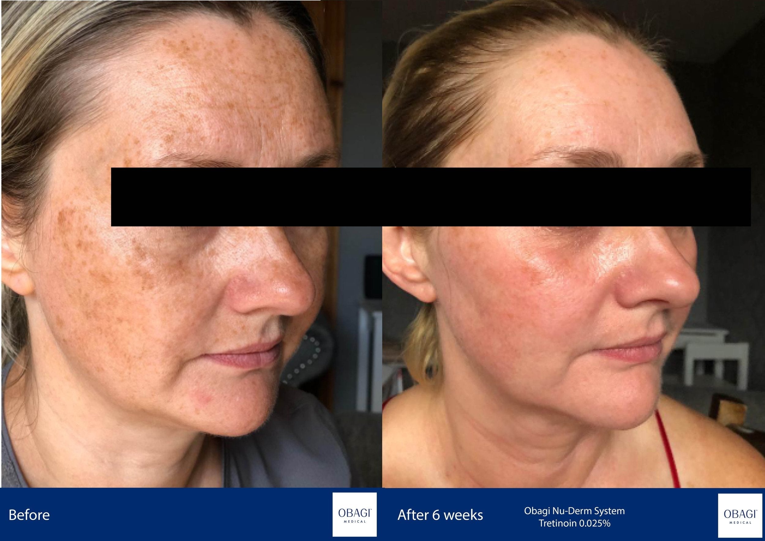 Nu-Derm Travel Kit - Normal to Oily. Before After. Obagi Medical. Worldwide international shipping. Official stockist. UK Ambassador Clinic.