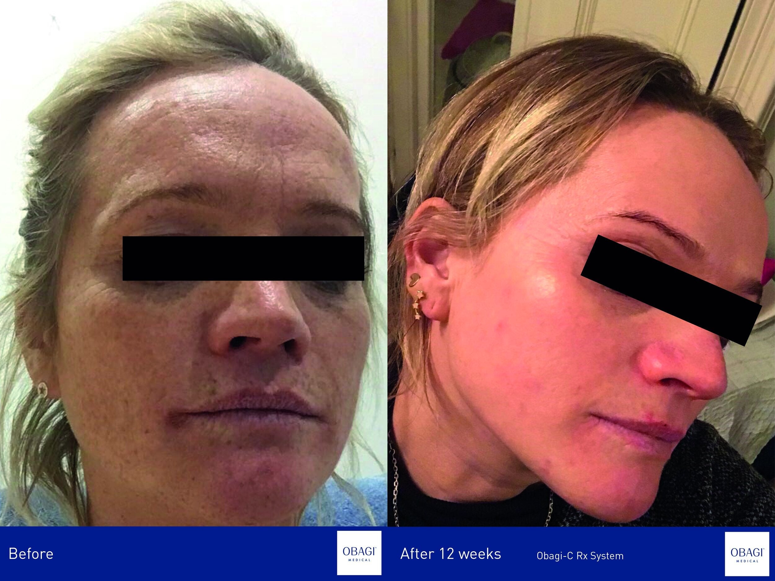 Obagi-C Rx C-Clarifying Serum - Normal to Dry. Before After. Obagi Medical. Worldwide international shipping. Official stockist. UK Ambassador Clinic.