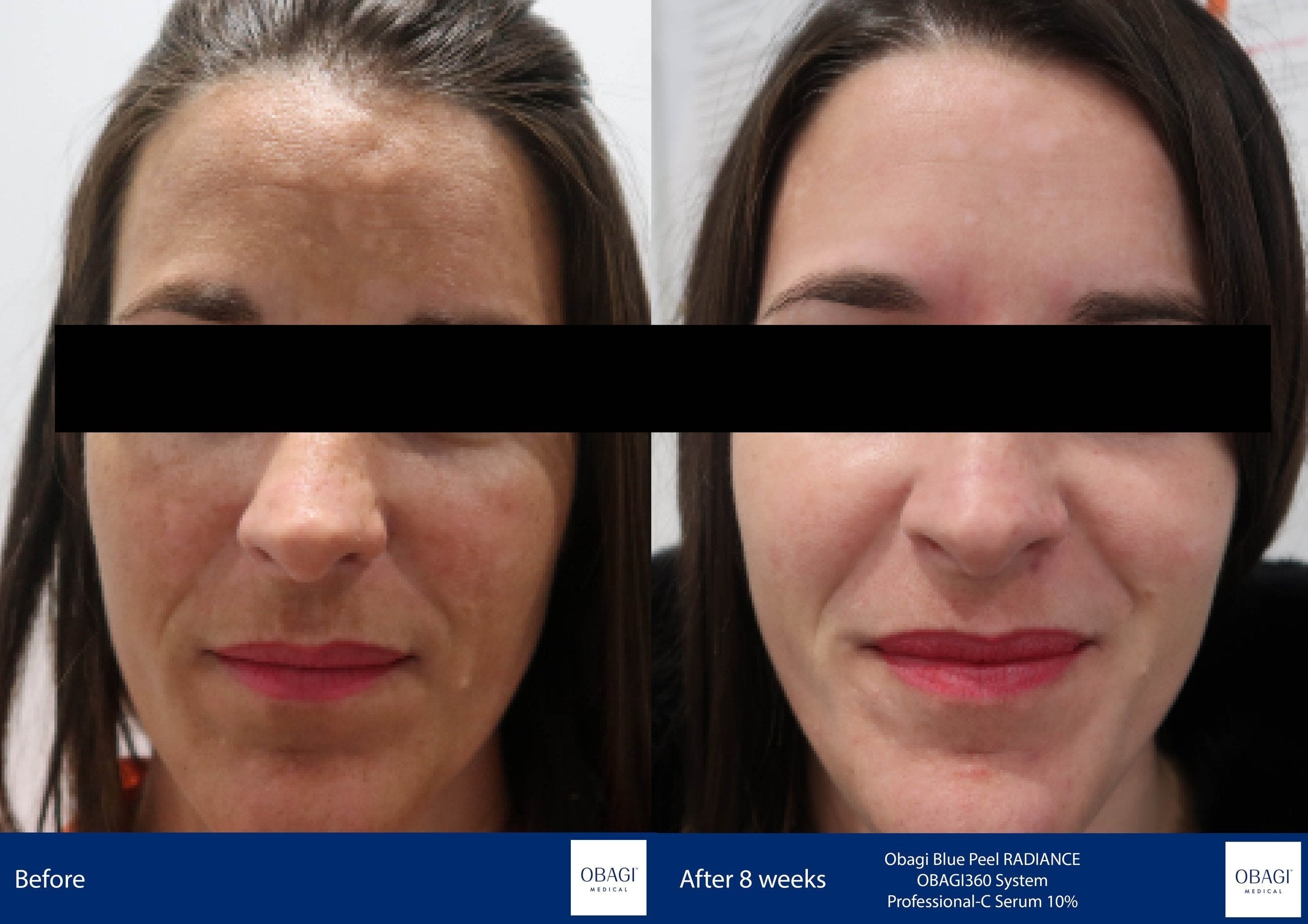 Obagi360 System. Before After. Obagi Medical. Worldwide international shipping. Official stockist. UK Ambassador Clinic.